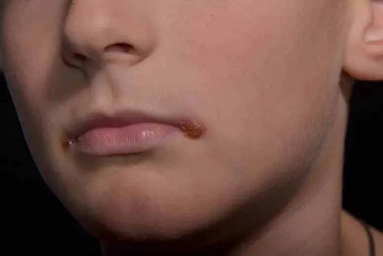 Skuteczne metody na zajady u dziecka - jak leczyć i zapobiegać?