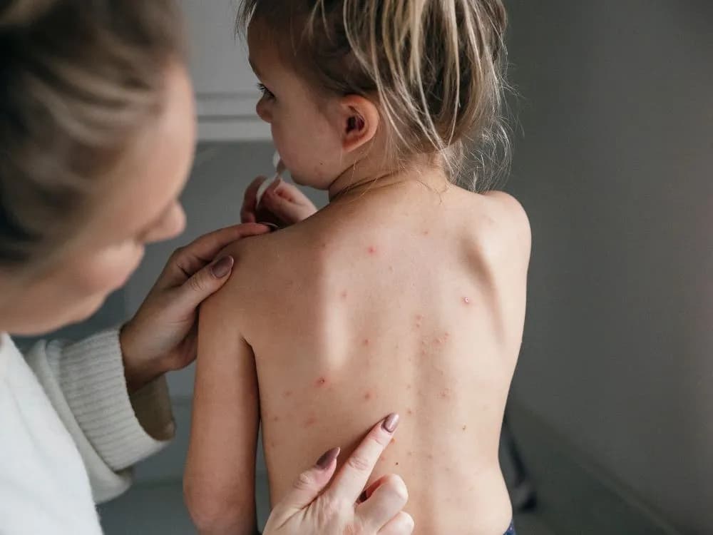 Co na ospę u dziecka - skuteczne metody łagodzenia objawów